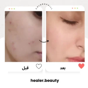 after-before-healer-chlorophill
